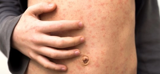 Do you need a measles booster?