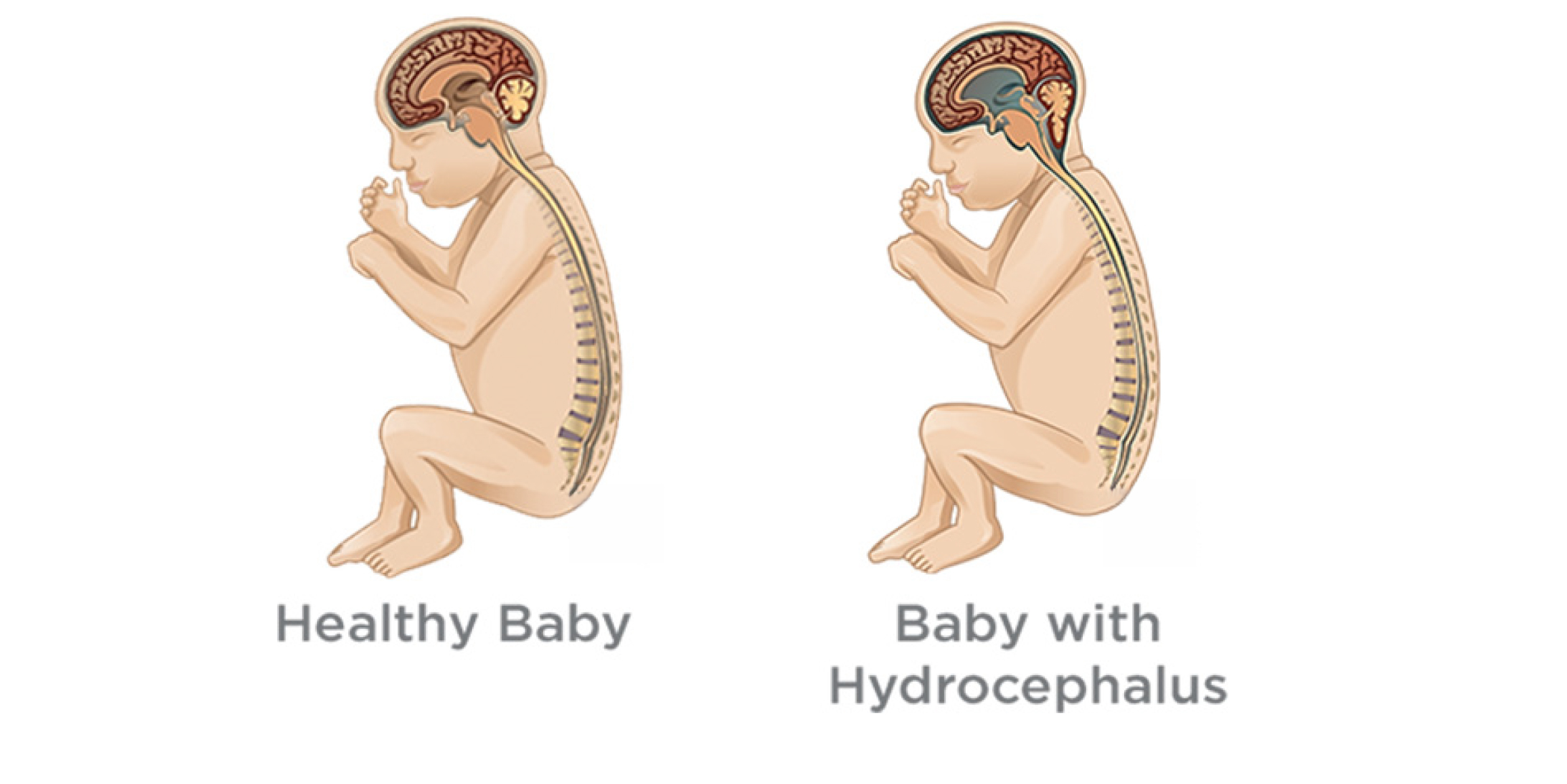 water on brain shows extra fluid around the brain