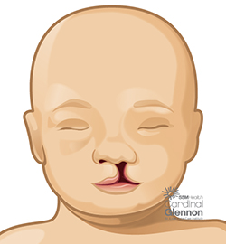 Cleft Lip Unilateral