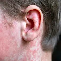 photo of persons ear with measels