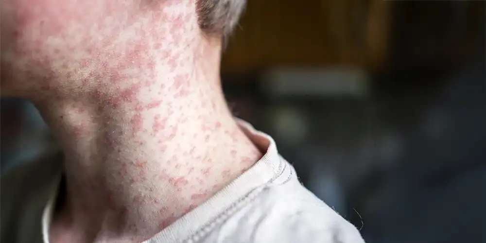 young boy with measles rash on face and neck
