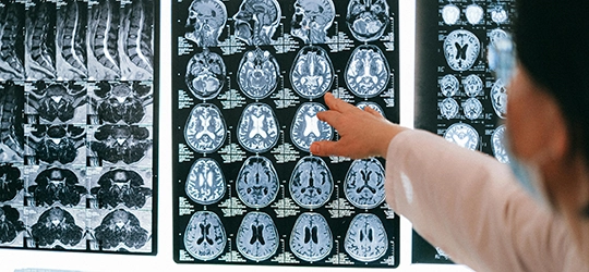 doctor looking at brain scan