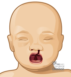Cleft Lip & Palate