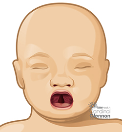 Cleft Palate