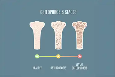 bone gets more spaces as osteoporosis progress