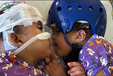 Twins cuddling post separation surgery