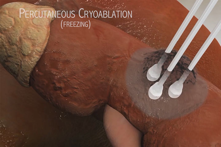 percutaneous cryoblation graphic