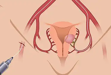 uterine fibroid embolization graphic