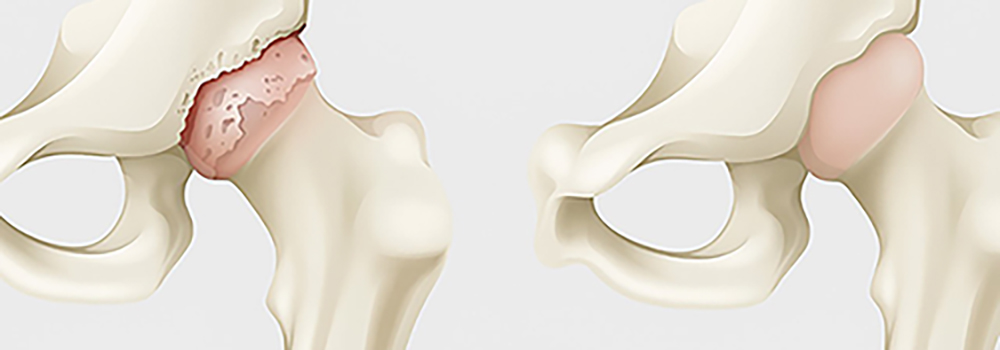 image of functioning hip and hip with arthritis
