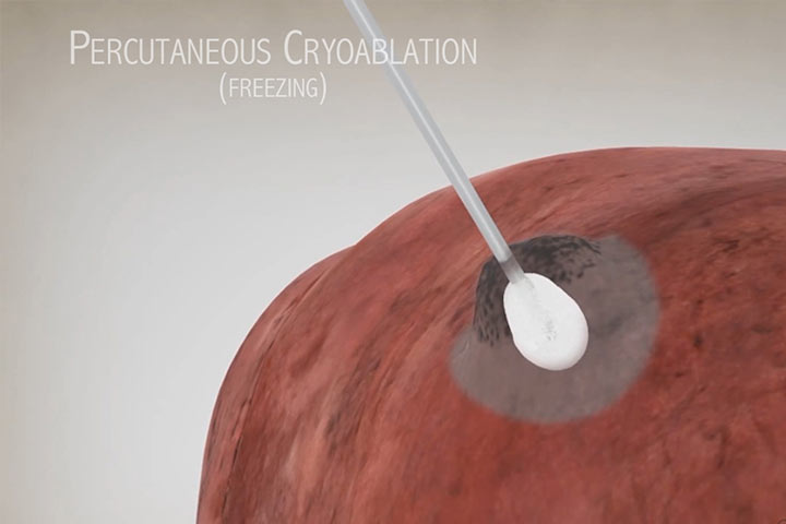 picture of ablation in tumor