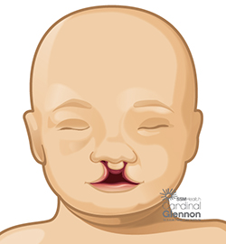 Cleft Palate Bilateral